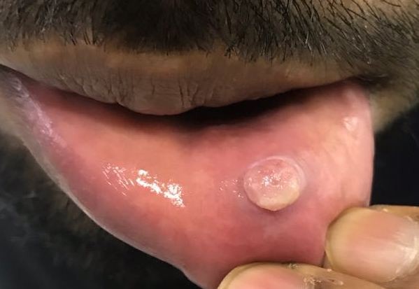 Lip swelling / growth case