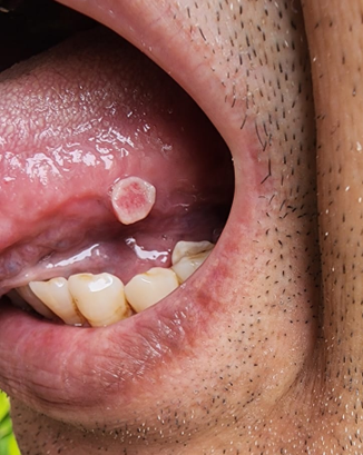 Tongue growth case