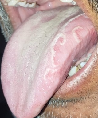 Tongue lesion case